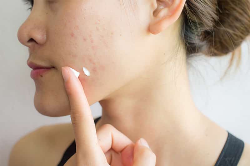 Woman with acne