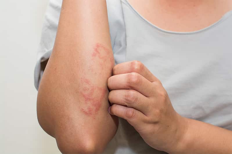 Woman with eczema on elbow