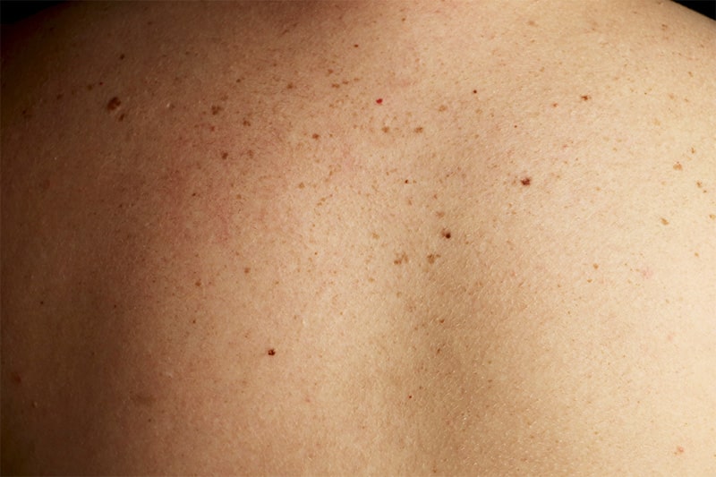 moles on back