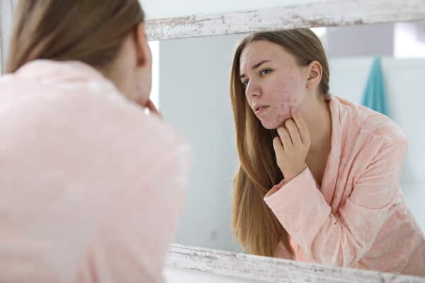 Woman with acne