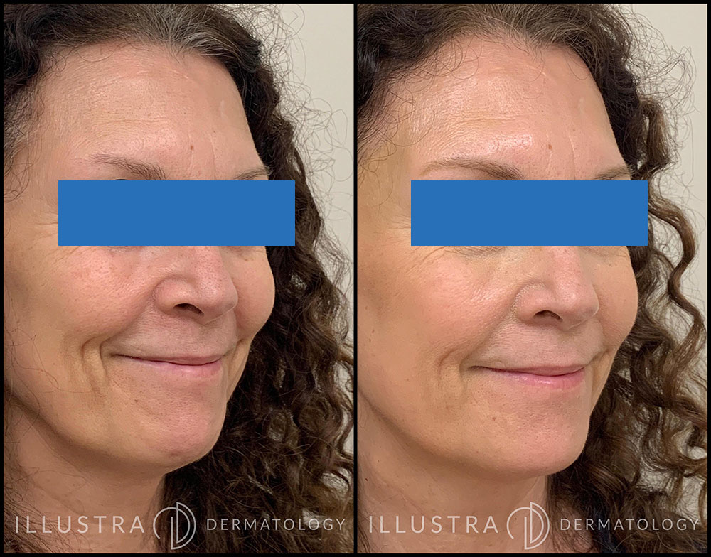 Before & After Filler