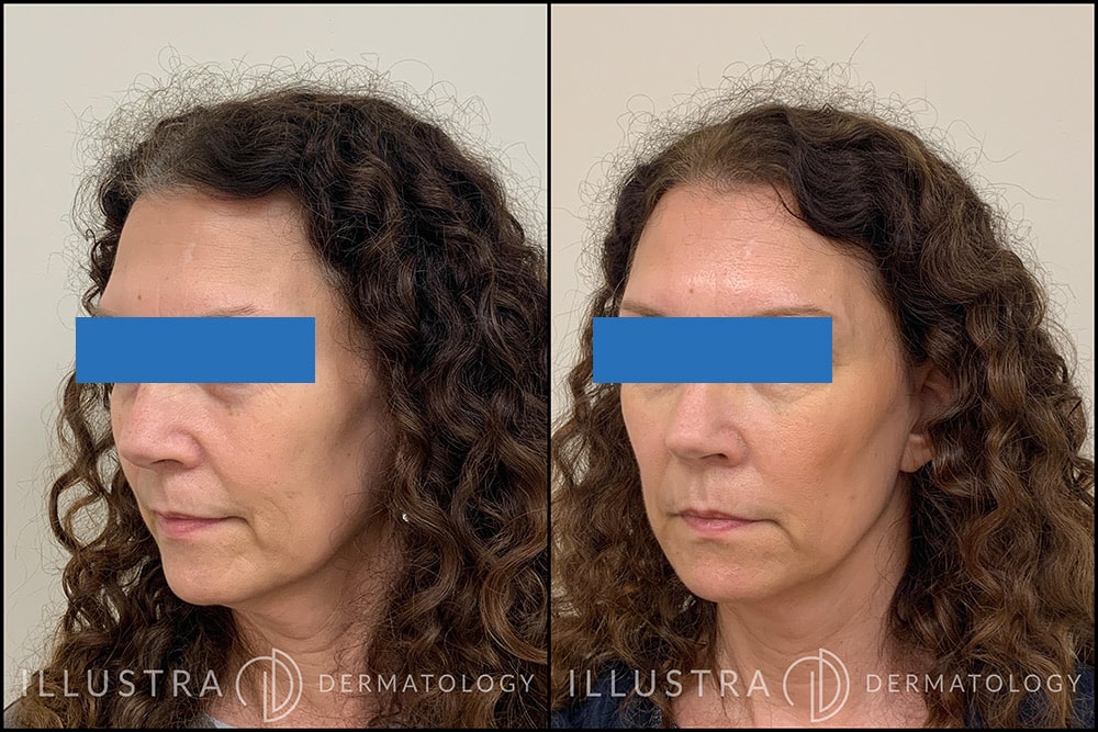 Before & After Filler