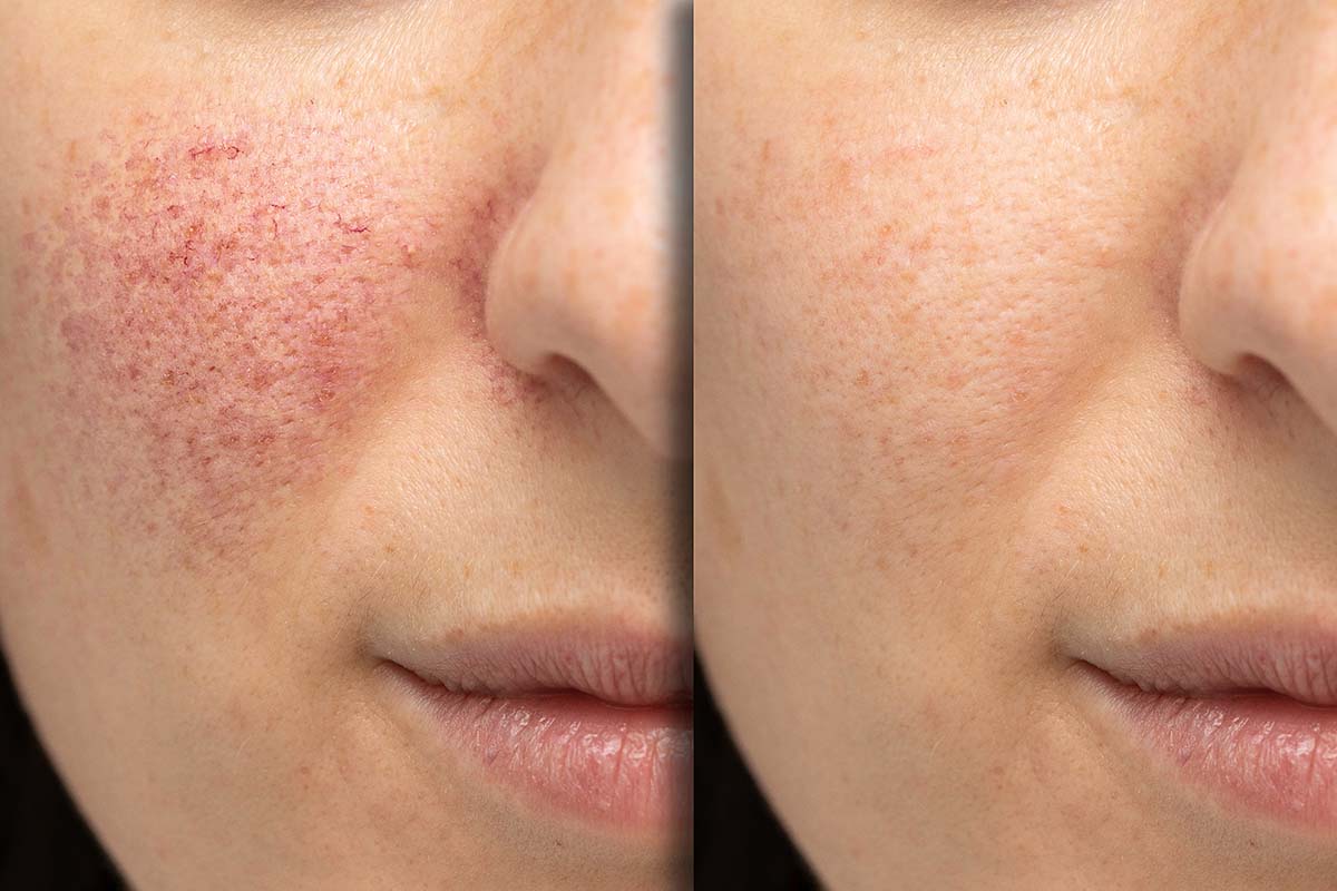 Before & After Laser Treatment