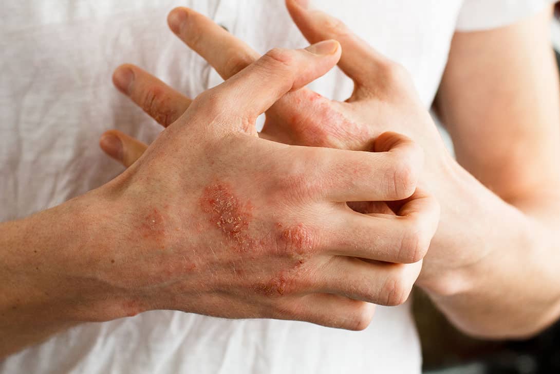Eczema on Hands
