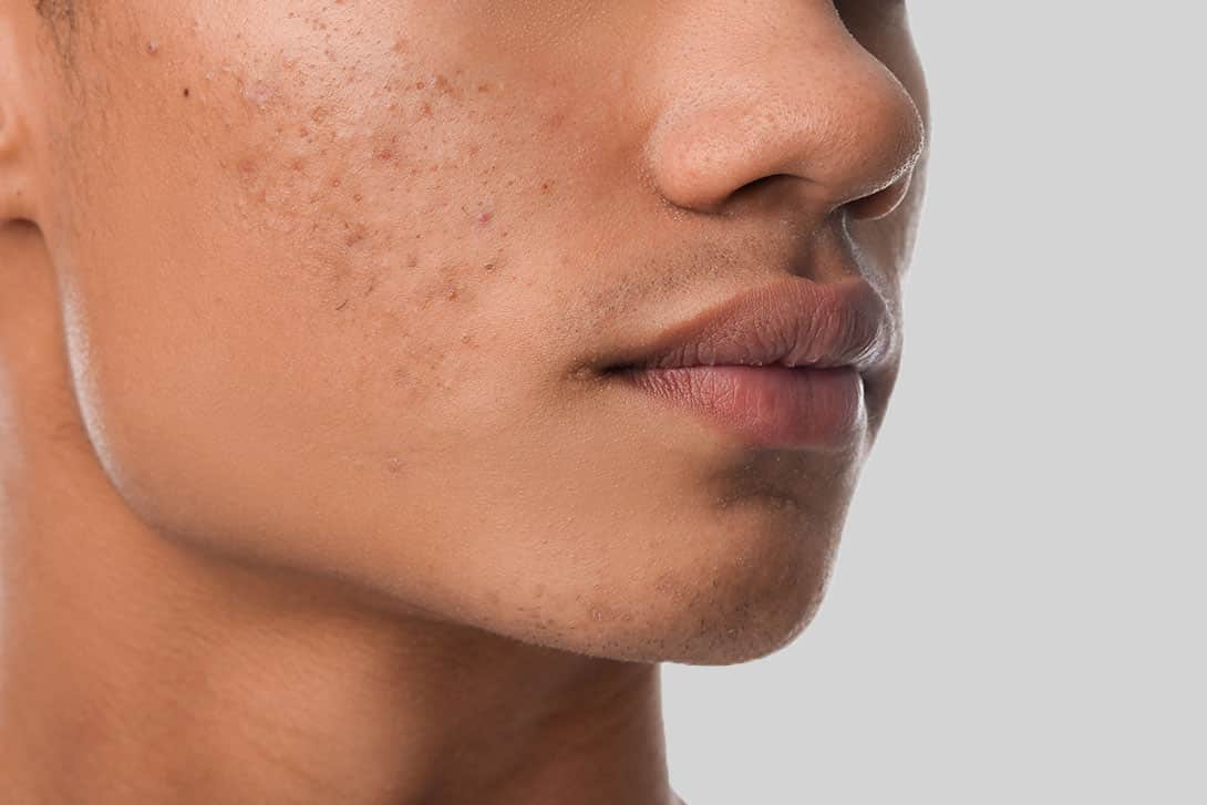 Ethnic Skin Acne