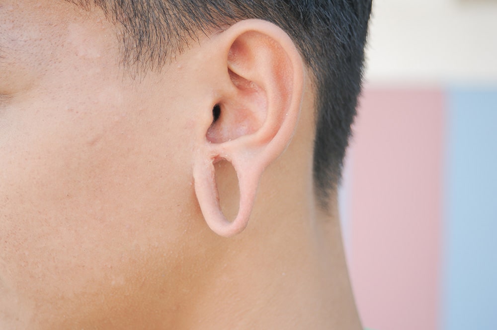 Bay Area Earlobe Repair, Stretched Ears