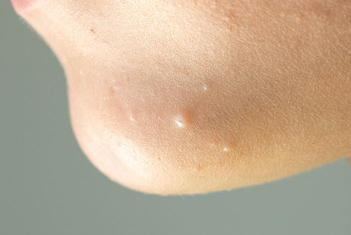 Molluscum contagiosum