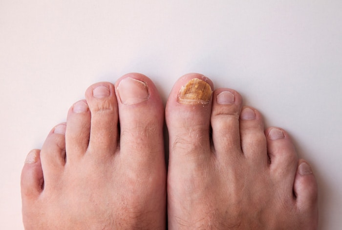 Nail diseases onychomycosis fungal infection Vector Image